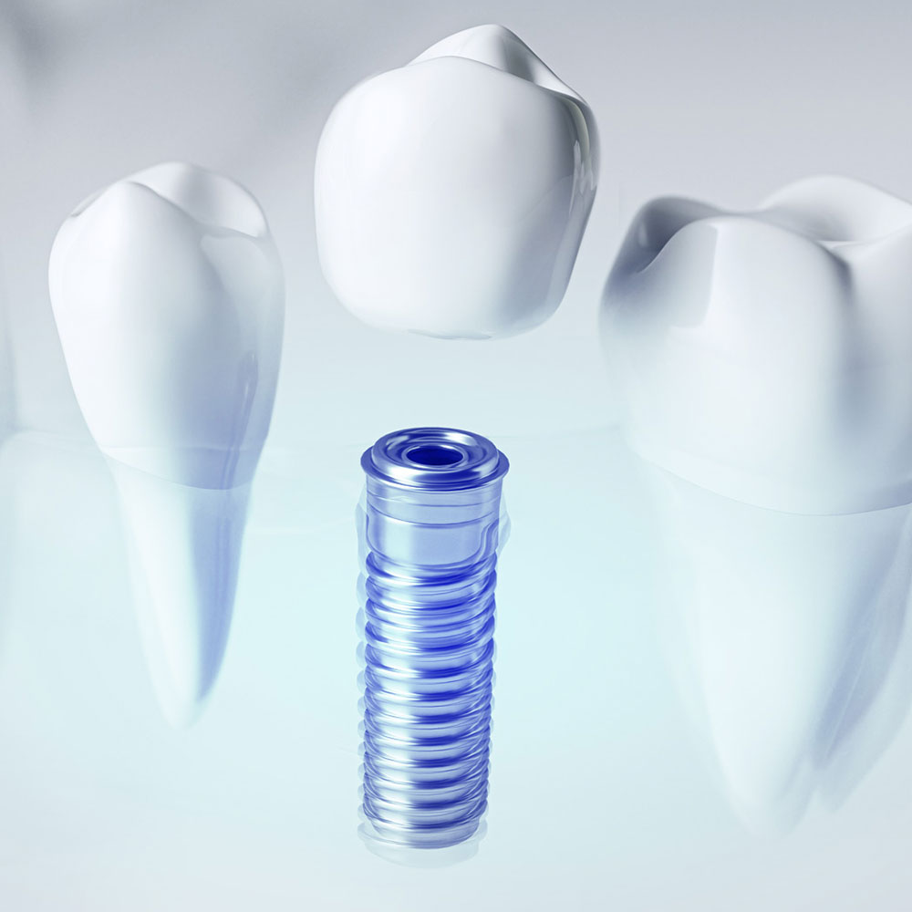 Implants dentaires