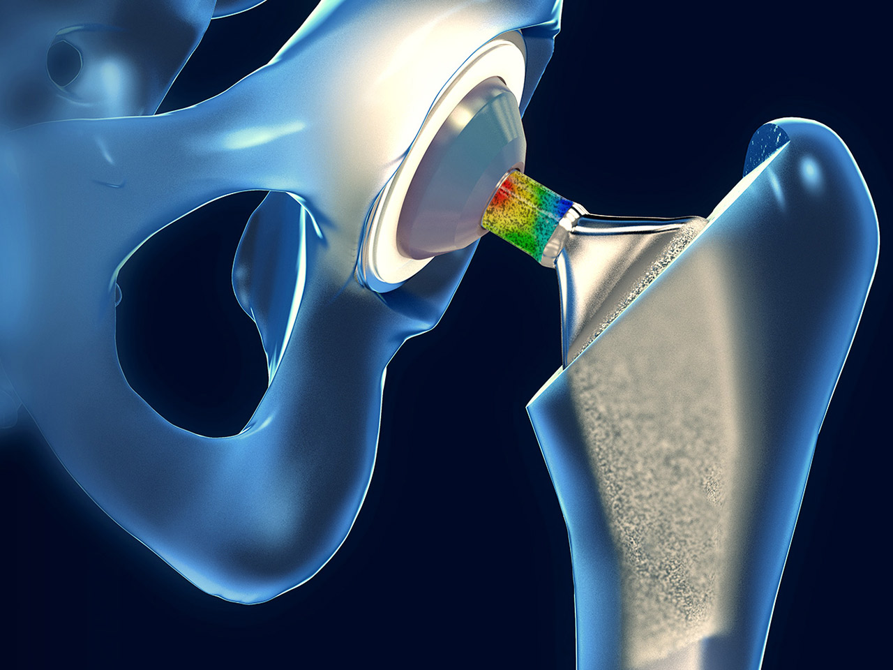 Analyse des propriétés mécaniques d'un implant de hanche