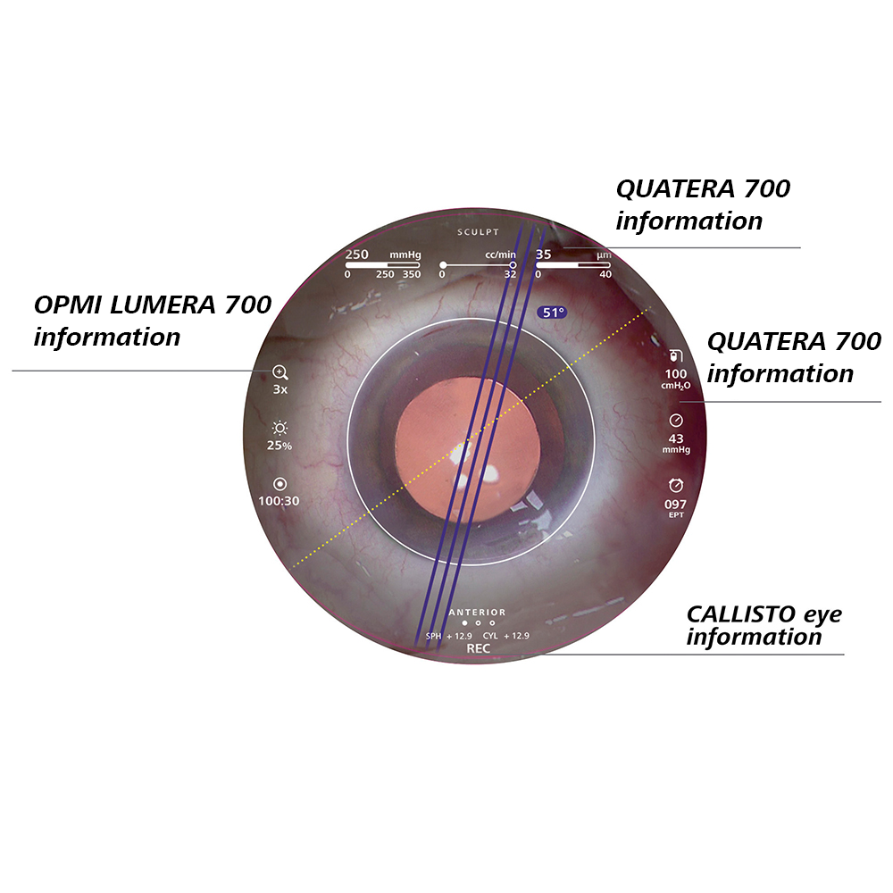 Fonctions d'assistance à chaque étape de la chirurgie de la cataracte