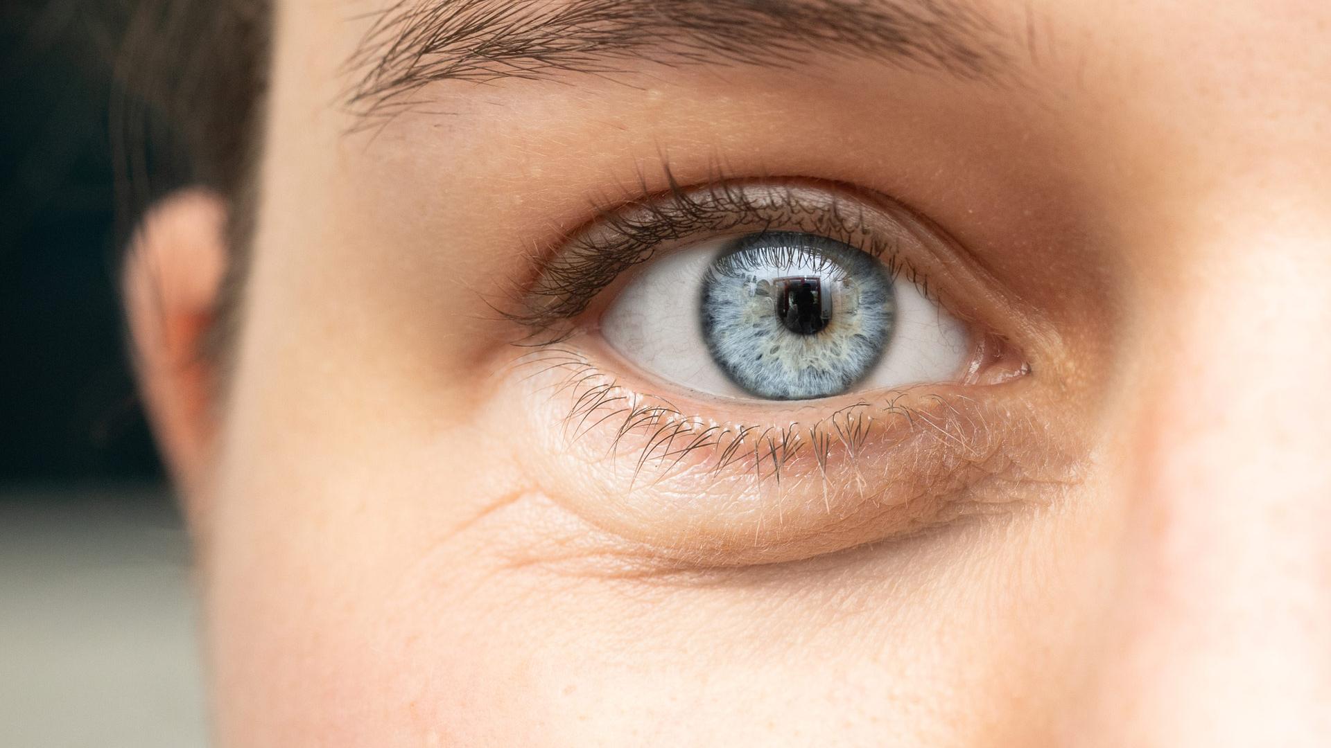Yeux gonflés, cernés ; rougeurs et sensations de brûlures oculaires
