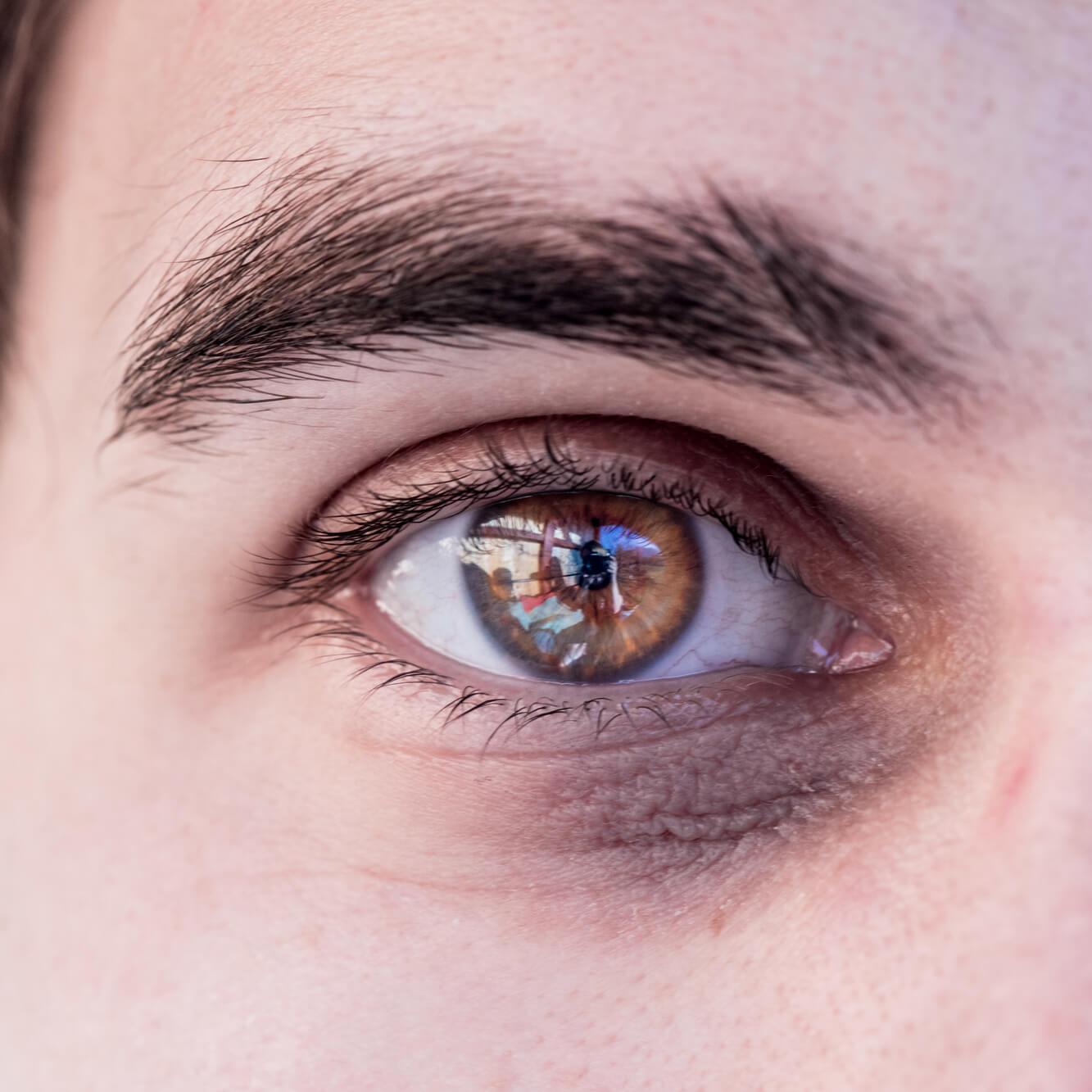 L’apparition de poches sous les yeux peut être exacerbée par le manque de sommeil, le régime alimentaire, le stress ainsi que le mode de vie.
