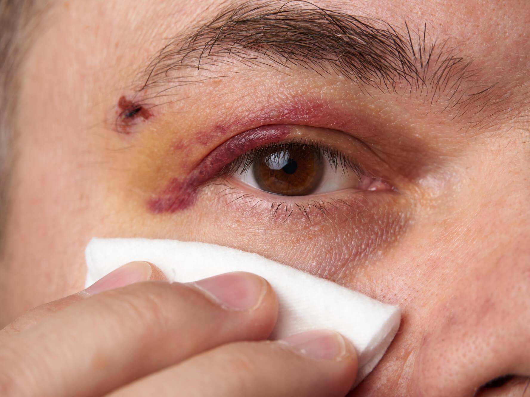 Appliquer une compresse froide sur l’œil juste après la blessure peut permettre de résorber l’œdème et apaiser la douleur.