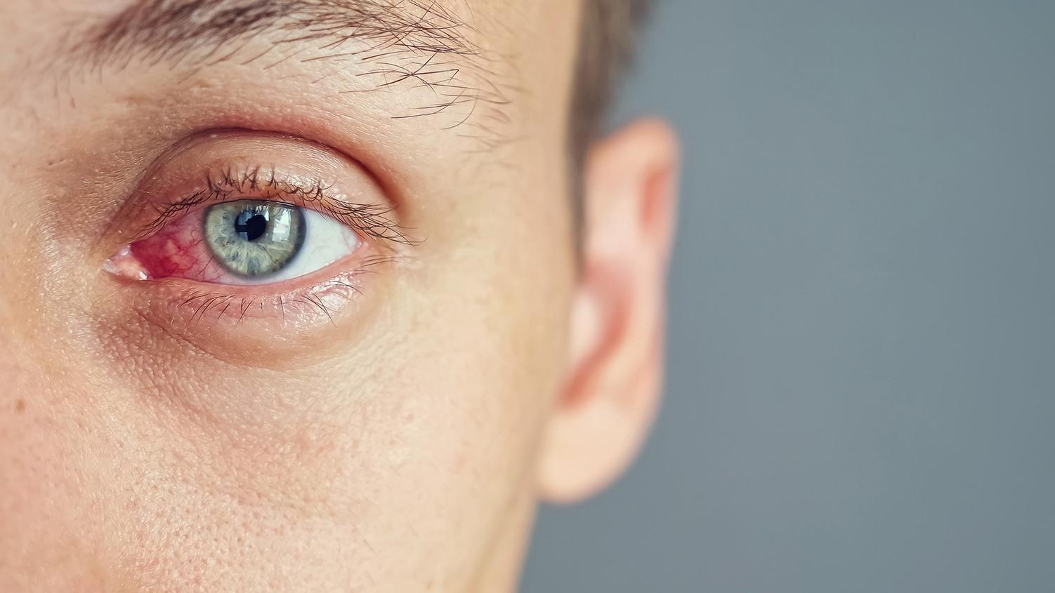 L’inflammation oculaire