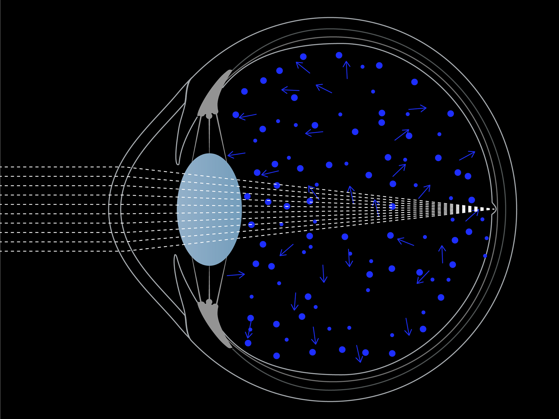 Visualisation schématique de la diffusion de la lumière bleue dans l&apos;œil.