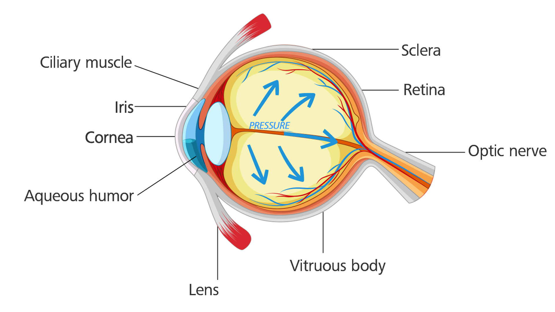 Œil atteint d'un glaucome : la tension oculaire augmente et endommage le nerf optique.